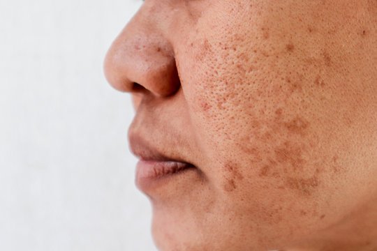 Dark Spots Treatment