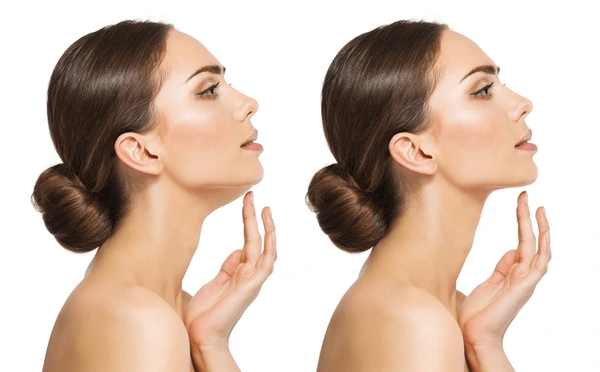 Double Chin Reduction Treatment