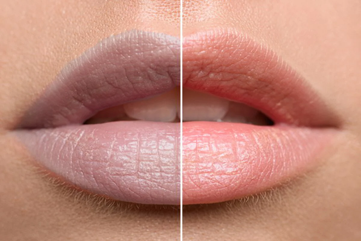 Lip Pigmentation Treatment