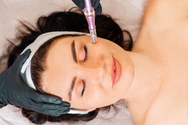 Micro-Needling Treatment