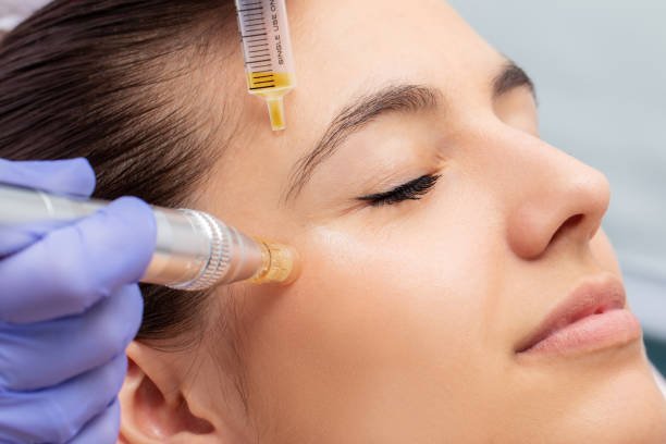 Microneedling